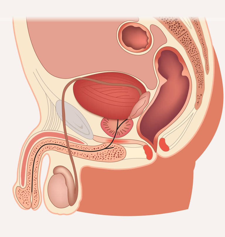 Cancerul de prostata – optiuni terapeutice ultramoderne
